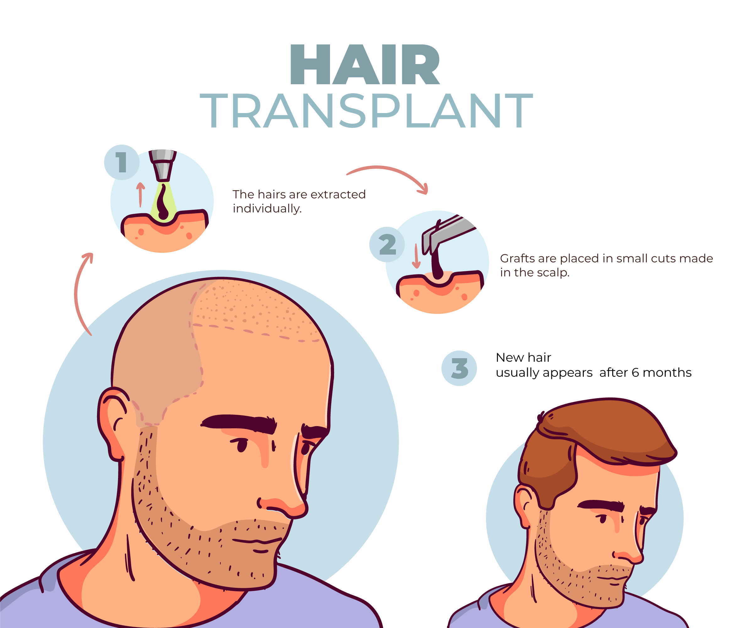 Hair Transplant in Nashik