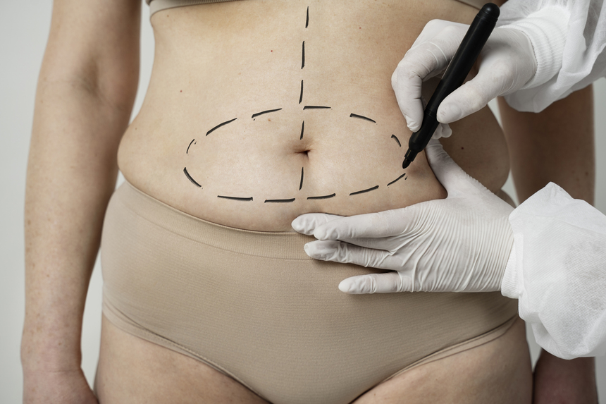 Liposuction in Gangapur Road Nashik