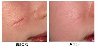Scar Laser Treatment in Gangapur Road Nashik
