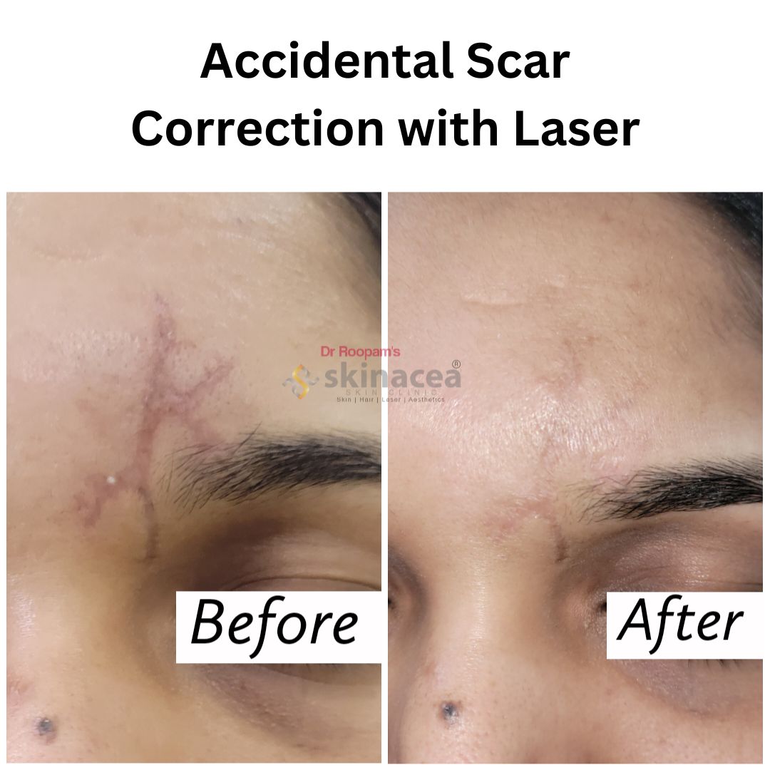 Scar Laser Treatment in Indira Nagar Nashik